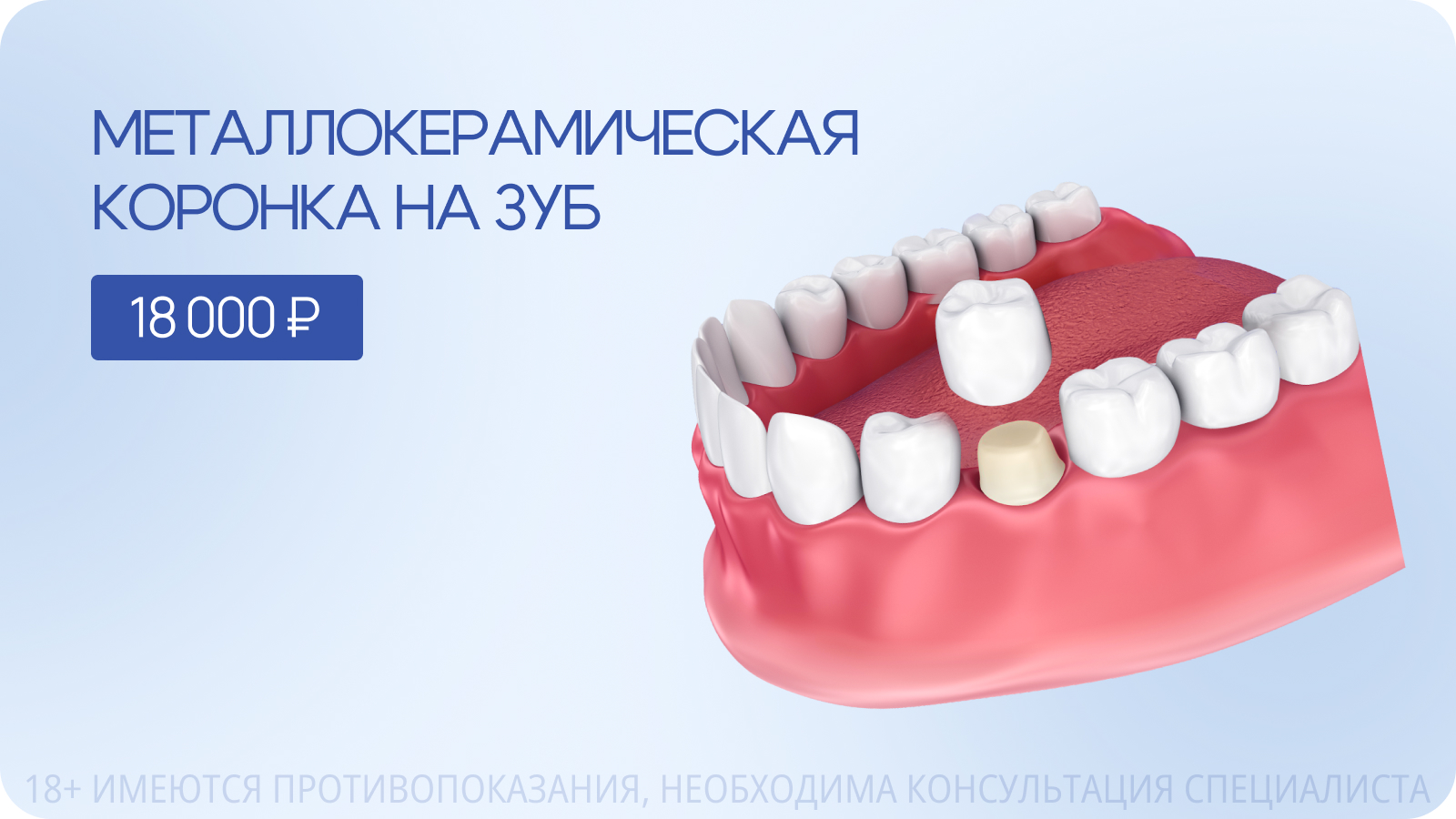 Металлокерамическая коронка