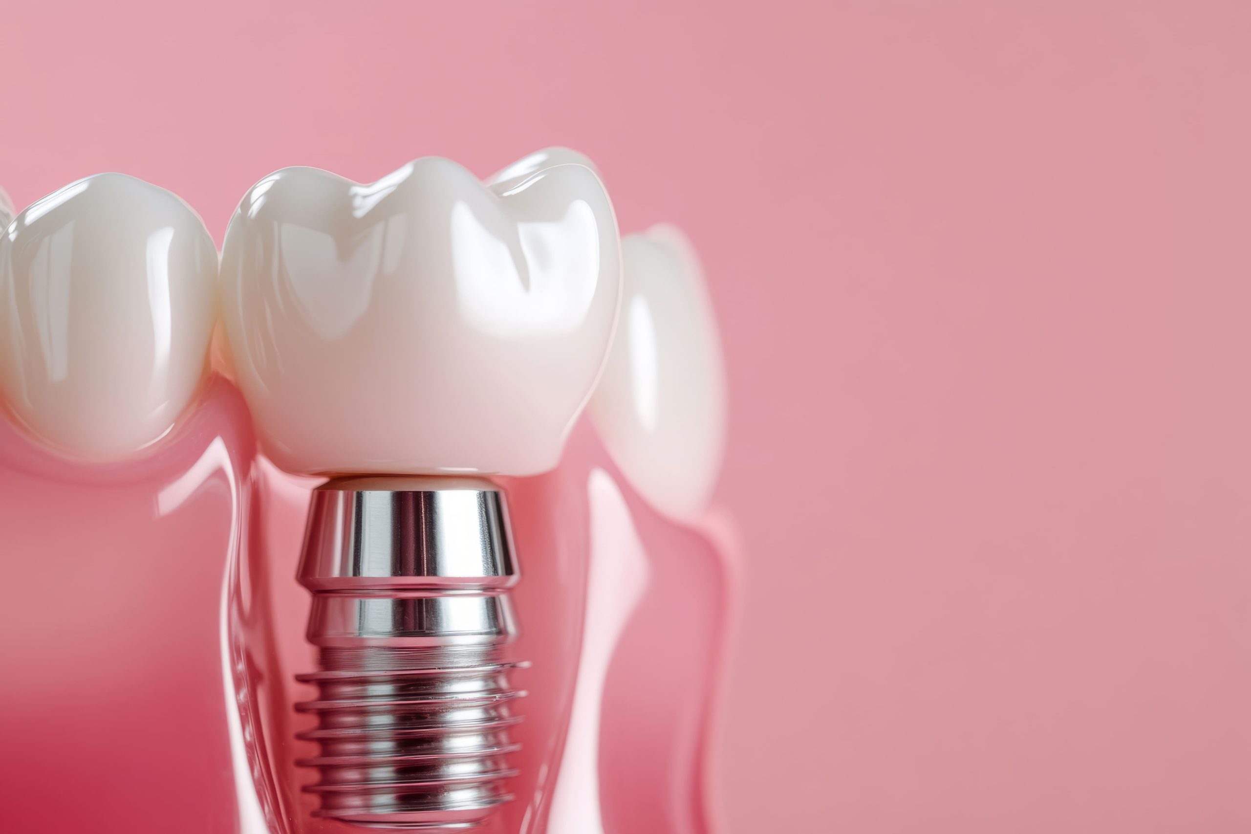 Анестезия при имплантации по методу All on 4 в Санкт-Петербурге: как проходит восстановление после имплантации | Зубной Центр СПБ