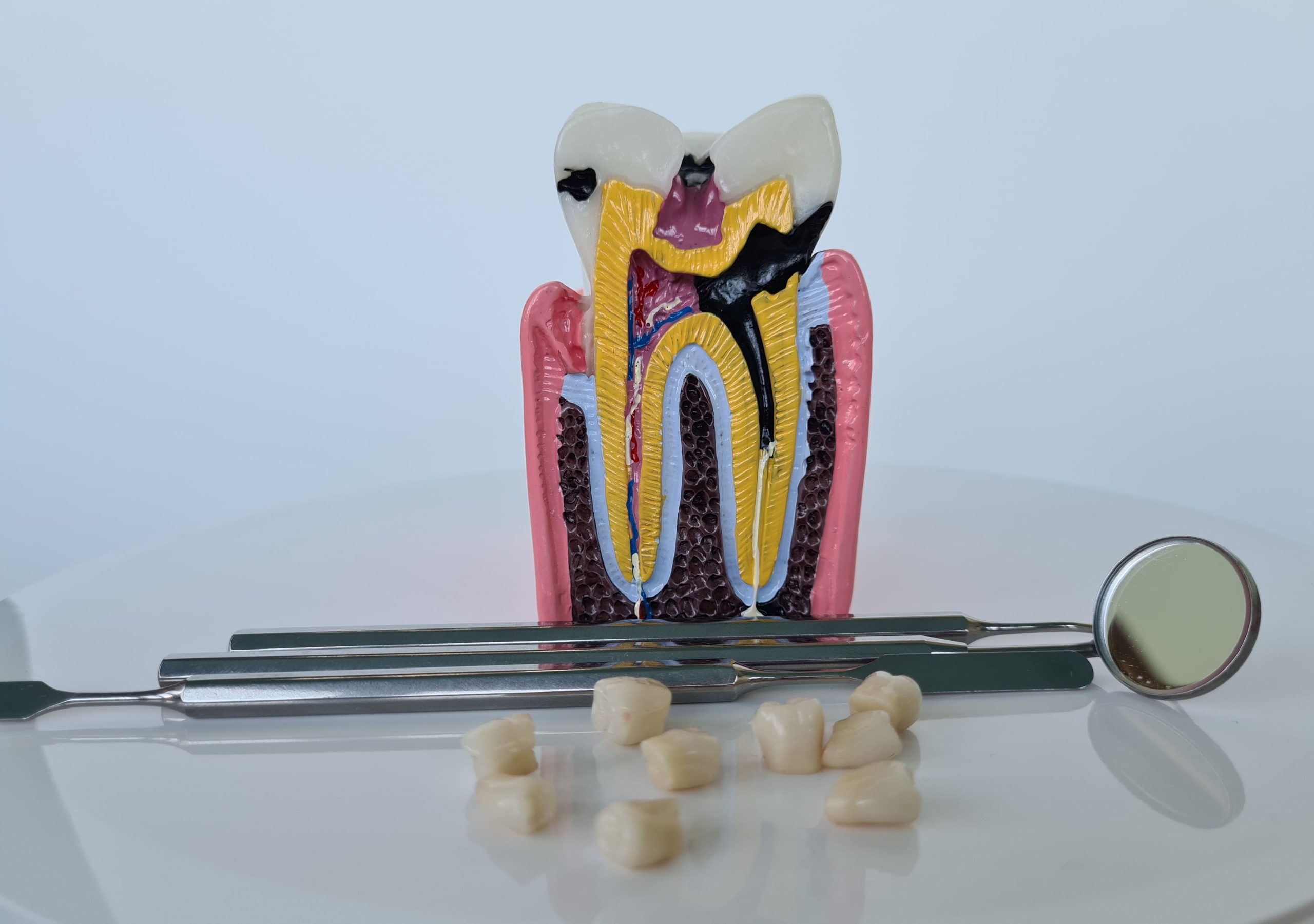 Лечение глубокого кариеса в Санкт-Петербурге: лечение зуба без удаления | Зубной Центр СПБ