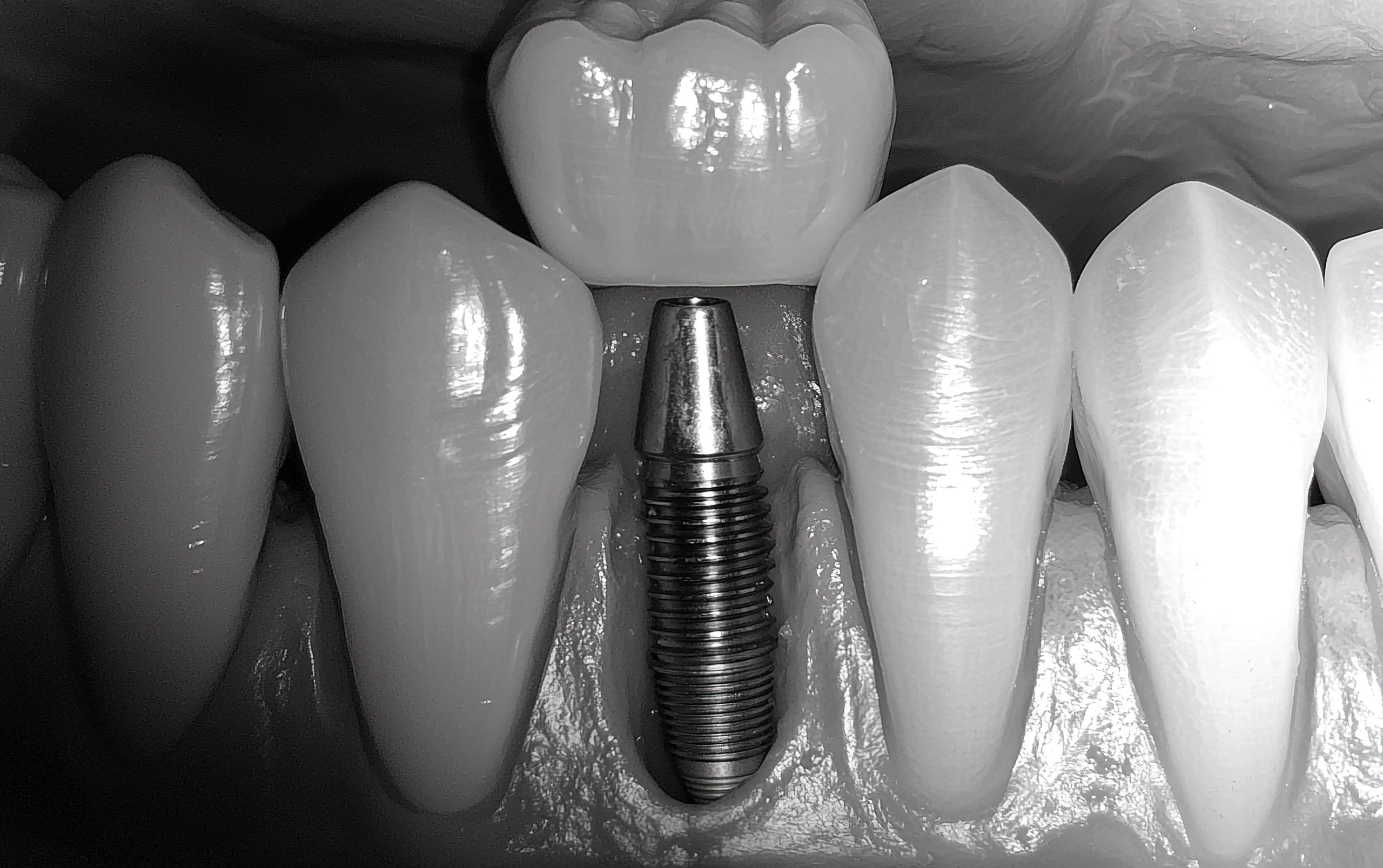 Восстановление зубного ряда при пародонтите по методике All-on-4 в Санкт-Петербурге: какие бывают противопоказания к имплантации зубов | Зубной Центр СПБ